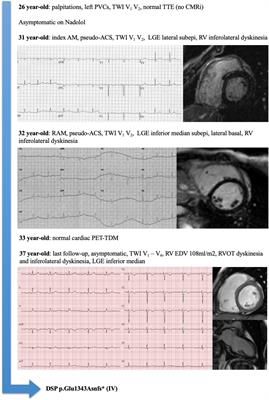 Recurrent acute myocarditis: An under-recognized clinical entity associated with the later diagnosis of a genetic arrhythmogenic cardiomyopathy